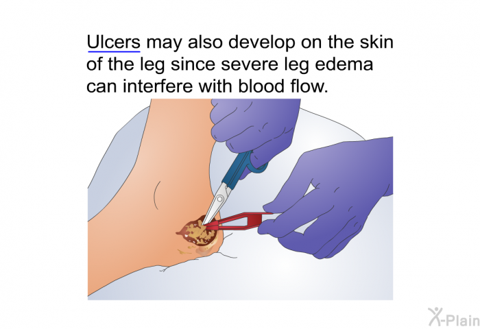 Ulcers may also develop on the skin of the leg since severe leg edema can interfere with blood flow.