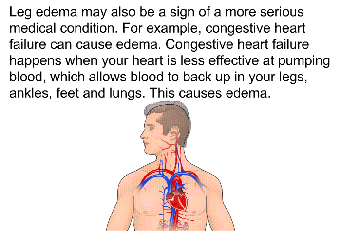 Leg edema may also be a sign of a more serious medical condition. For example, congestive heart failure can cause edema. Congestive heart failure happens when your heart is less effective at pumping blood, which allows blood to back up in your legs, ankles, feet and lungs. This causes edema.