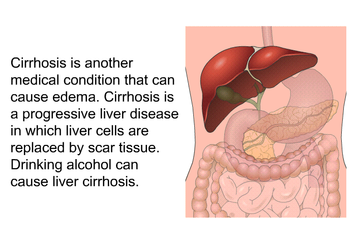 Cirrhosis is another medical condition that can cause edema. Cirrhosis is a progressive liver disease in which liver cells are replaced by scar tissue. Drinking alcohol can cause liver cirrhosis.