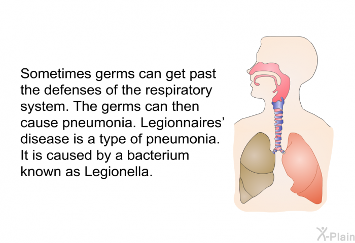 Sometimes germs can get past the defenses of the respiratory system. The germs can then cause pneumonia. Legionnaires' disease is a type of pneumonia. It is caused by a bacterium known as Legionella.