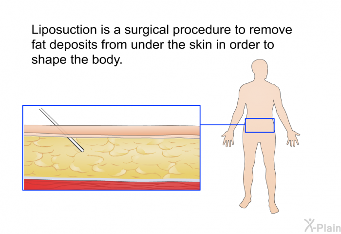 Liposuction is a surgical procedure to remove fat deposits from under the skin in order to shape the body.