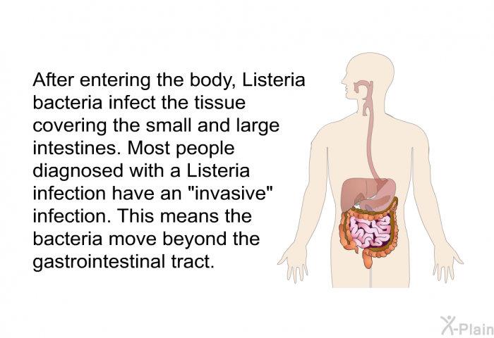 After entering the body, Listeria bacteria infect the tissue covering the small and large intestines. Most people diagnosed with a listeria infection have an "invasive" infection. This means the bacteria move beyond the gastrointestinal tract.