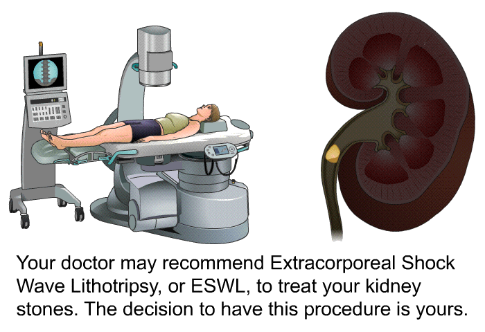 Your doctor may recommend Extracorporeal Shock Wave Lithotripsy, or ESWL, to treat your kidney stones. The decision to have this procedure is yours.