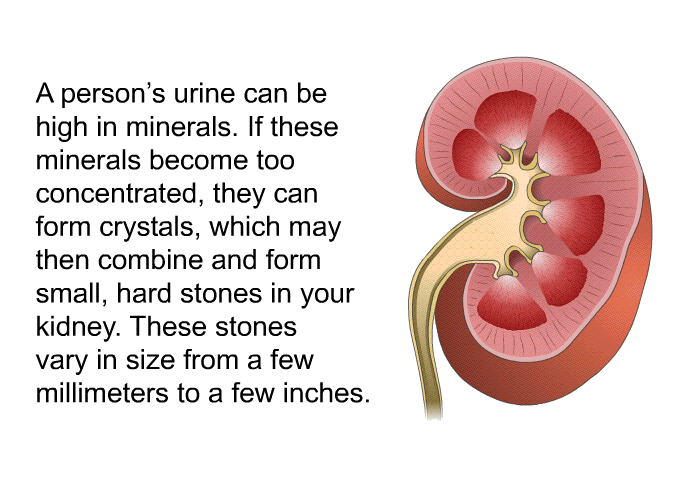 A person's urine can be high in minerals. If these minerals become too concentrated, they can form crystals, which may then combine and form small, hard stones in your kidney. These stones vary in size from a few millimeters to a few inches.
