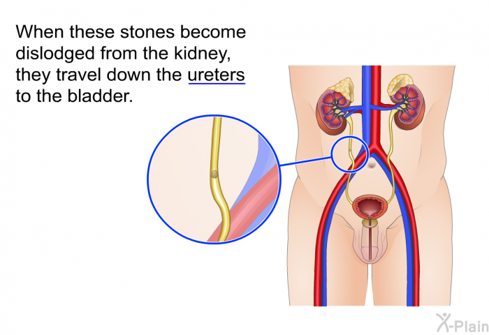 When these stones become dislodged from the kidney, they travel down the ureters to the bladder.