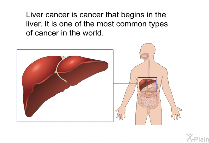 Liver cancer is cancer that begins in the liver. It is one of the most common types of cancer in the world.