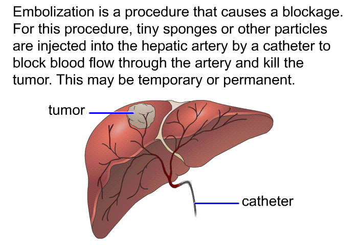 Embolization is a procedure that causes a blockage. For this procedure, tiny sponges or other particles are injected into the hepatic artery by a catheter to block blood flow through the artery and kill the tumor. This may be temporary or permanent.