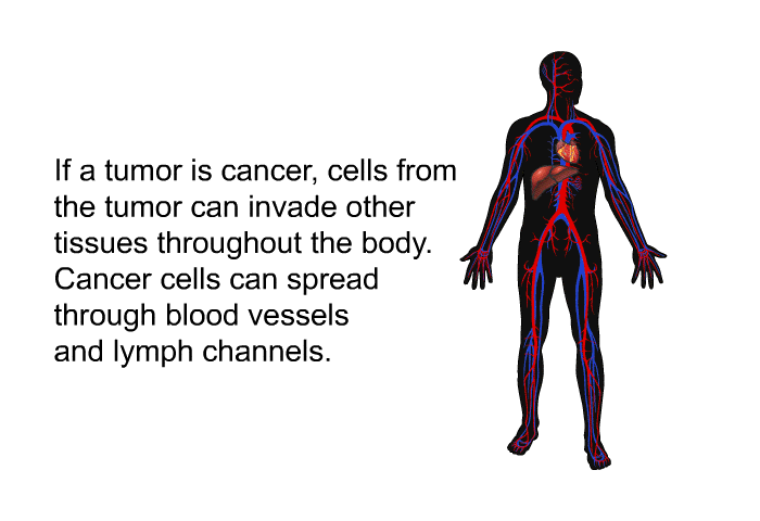 If a tumor is cancer, cells from the tumor can invade other tissues throughout the body. Cancer cells can spread through blood vessels and lymph channels.