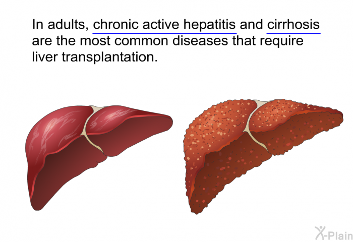 In adults, chronic active hepatitis and cirrhosis are the most common diseases that require liver transplantation.