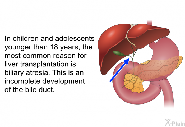 In children and adolescents younger than 18 years, the most common reason for liver transplantation is biliary atresia. This is an incomplete development of the bile duct.
