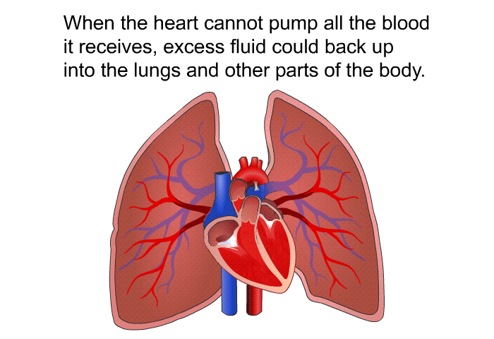 When the heart cannot pump all the blood it receives, excess fluid could back up into the lungs and other parts of the body.