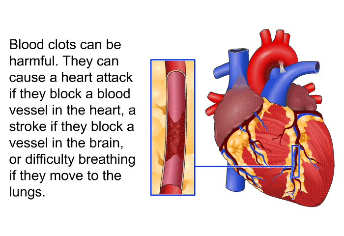 Blood clots can be harmful. They can cause a heart attack if they block a blood vessel in the heart, a stroke if they block a vessel in the brain, or difficulty breathing if they move to the lungs.