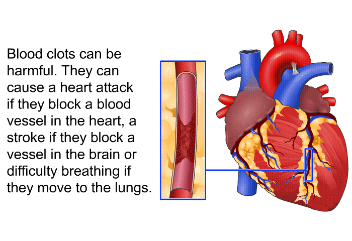 Blood clots can be harmful. They can cause a heart attack if they block a blood vessel in the heart, a stroke if they block a vessel in the brain or difficulty breathing if they move to the lungs.