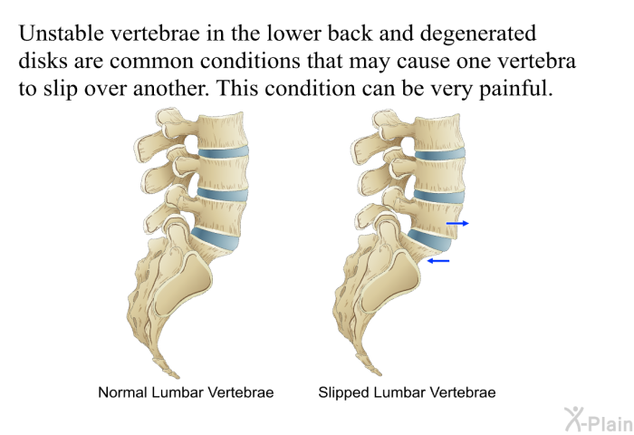 Unstable vertebrae in the lower back and degenerated disks are common conditions that may cause one vertebra to slip over another. This condition can be very painful.
