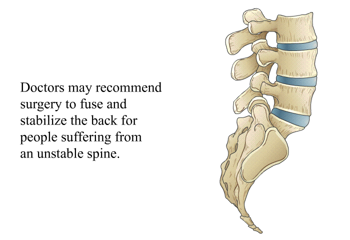 Doctors may recommend surgery to fuse and stabilize the back for people suffering from an unstable spine.