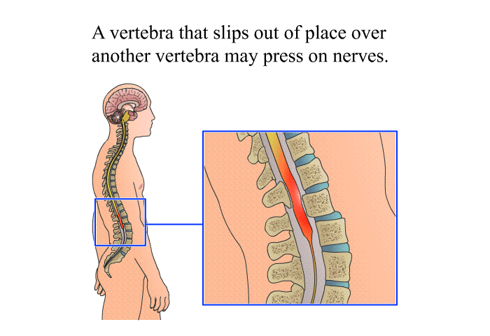 A vertebra that slips out of place over another vertebra may press on nerves.