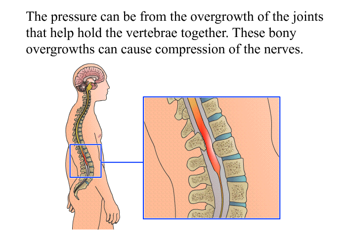 The pressure can be from the overgrowth of the joints that help hold the vertebrae together. These bony overgrowths can cause compression of the nerves.