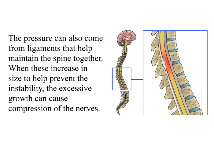 The pressure can also come from ligaments that help maintain the spine together. When these increase in size to help prevent the instability, the excessive growth can cause compression of the nerves.