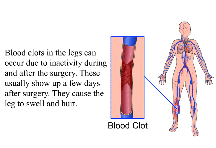 Blood clots in the legs can occur due to inactivity during and after the surgery. These usually show up a few days after surgery. They cause the leg to swell and hurt.
