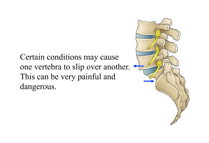 Certain conditions may cause one vertebra to slip over another. This can be very painful and dangerous.