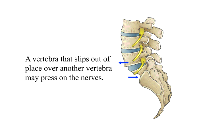 A vertebra that slips out of place over another vertebra may press on the nerves.
