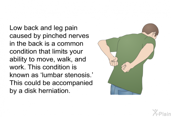 Low back and leg pain caused by pinched nerves in the back is a common condition that limits your ability to move, walk, and work. This condition is known as  lumbar stenosis.' This could be accompanied by a disk herniation.