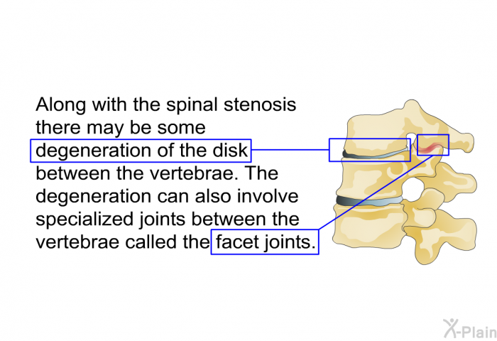 Along with the spinal stenosis there may be some degeneration of the disk between the vertebrae. The degeneration can also involve specialized joints between the vertebrae called the facet joints.