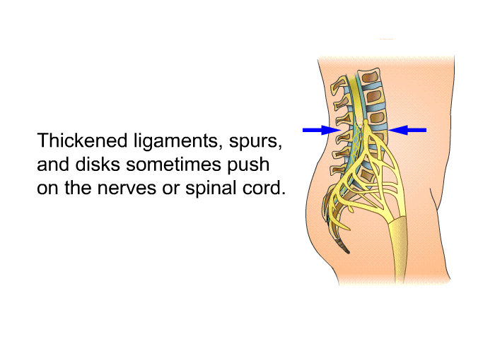 Thickened ligaments, spurs, and disks sometimes push on the nerves or spinal cord.