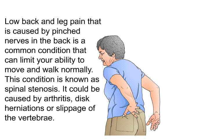 Low back and leg pain that is caused by pinched nerves in the back is a common condition that can limit your ability to move and walk normally. This condition is known as spinal stenosis. It could be caused by arthritis, disk herniations or slippage of the vertebrae.