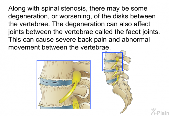 Along with spinal stenosis, there may be some degeneration, or worsening, of the disks between the vertebrae. The degeneration can also affect joints between the vertebrae called the facet joints. This can cause severe back pain and abnormal movement between the vertebrae.