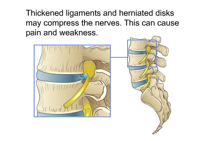 Thickened ligaments and herniated disks may compress the nerves. This can cause pain and weakness.