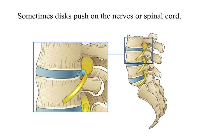 Sometimes disks push on the nerves or spinal cord.
