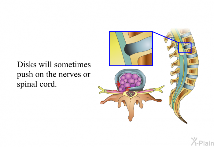 Disks will sometimes push on the nerves or spinal cord.