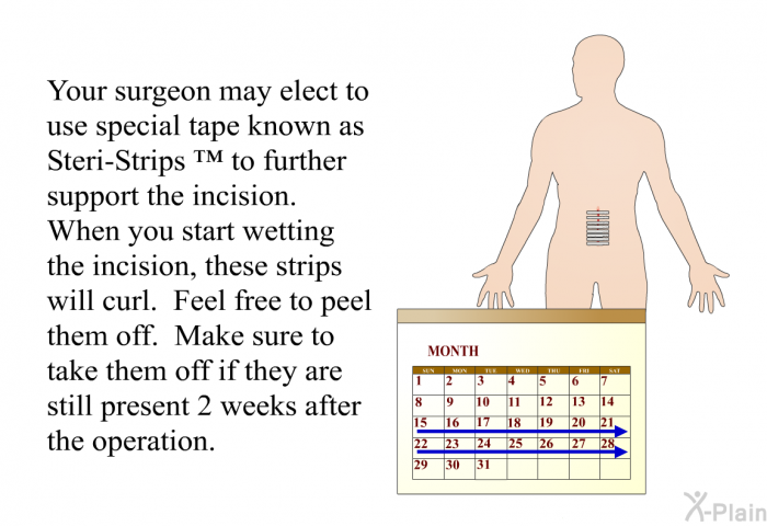 Your surgeon may elect to use special tape known as Steri-Strips ™ to further support the incision. When you start wetting the incision, these strips will curl. Feel free to peel them off. Make sure to take them off if they are still present 2 weeks after the operation.