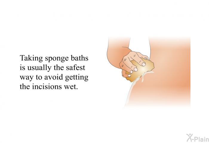 Taking sponge baths is usually the safest way to avoid getting the incisions wet.