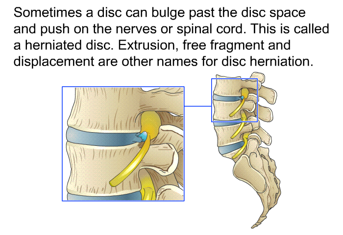 Sometimes a disc can bulge past the disc space and push on the nerves or spinal cord. This is called a herniated disc. Extrusion, free fragment and displacement are other names for disc herniation.