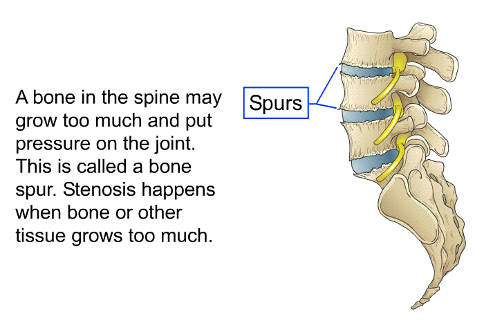 A bone in the spine may grow too much and put pressure on the joint. This is called a bone spur. Stenosis happens when bone or other tissue grows too much.