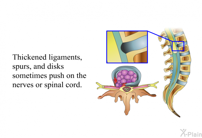 Thickened ligaments, spurs, and disks sometimes push on the nerves or spinal cord.