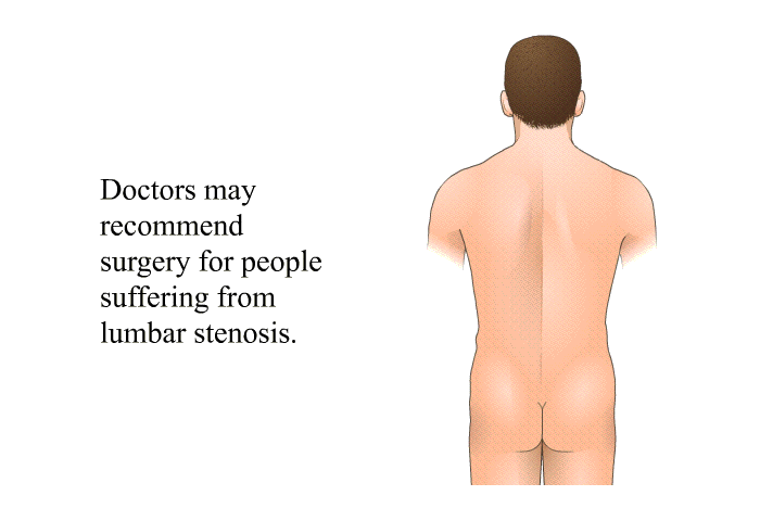 Doctors may recommend surgery for people suffering from lumbar stenosis.