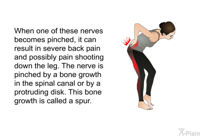 When one of these nerves becomes pinched, it can result in severe back pain and possibly pain shooting down the leg. The nerve is pinched by a bone growth in the spinal canal or by a protruding disk. This bone growth is called a spur.