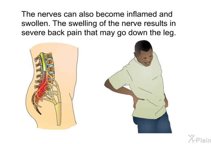 The nerves can also become inflamed and swollen. The swelling of the nerve results in severe back pain that may go down the leg.