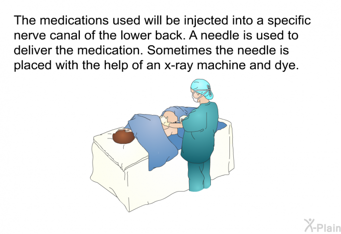 The medications used will be injected into a specific nerve canal of the lower back. A needle is used to deliver the medication. Sometimes the needle is placed with the help of an x-ray machine and dye.