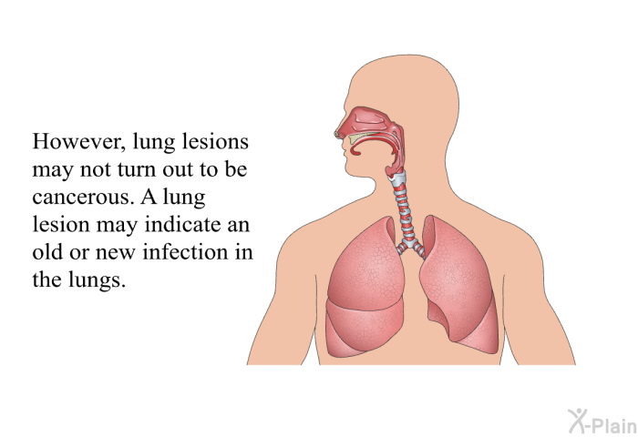 However, lung lesions may not turn out to be cancerous. A lung lesion may indicate an old or new infection in the lungs.