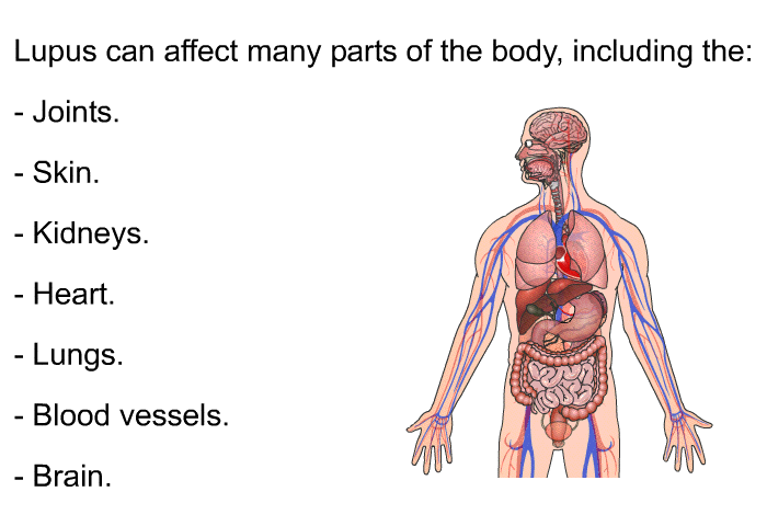 Lupus can affect many parts of the body, including the:  Joints. Skin. Kidneys. Heart. Lungs. Blood vessels. Brain.