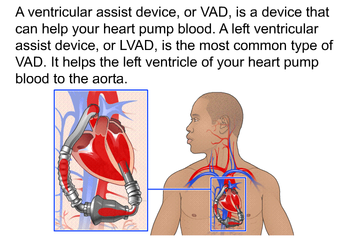 A ventricular assist device, or VAD, is a device that can help your heart pump blood. A left ventricular assist device, or LVAD, is the most common type of VAD. It helps the left ventricle of your heart pump blood to the aorta.
