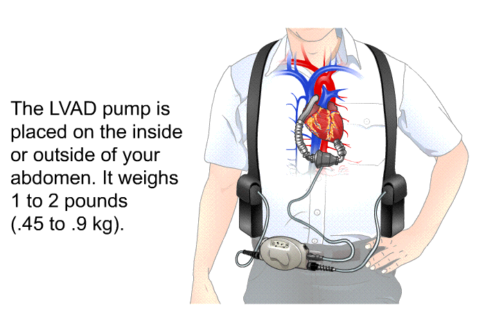 The LVAD pump is placed on the inside or outside of your abdomen. It weighs 1 to 2 pounds (.45 to .9 kg).