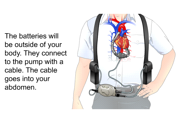 The batteries will be outside of your body. They connect to the pump with a cable. The cable goes into your abdomen.