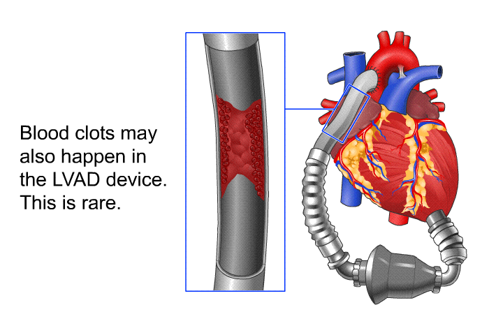 Blood clots may also happen in the LVAD device. This is rare.