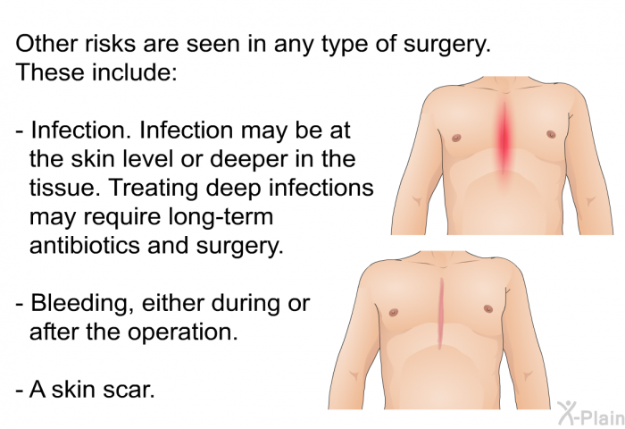 Other risks are seen in any type of surgery. These include:  Infection. Infection may be at the skin level or deeper in the tissue. Treating deep infections may require long-term antibiotics and surgery. Bleeding, either during or after the operation. A skin scar.