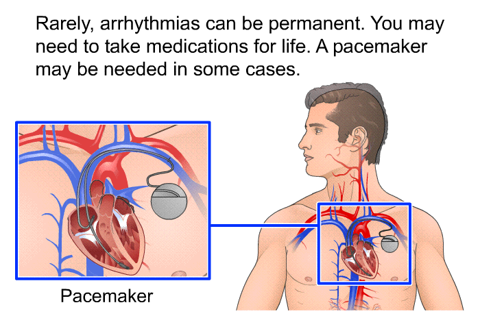 Rarely, arrhythmias can be permanent. You may need to take medications for life. A pacemaker may be needed in some cases.